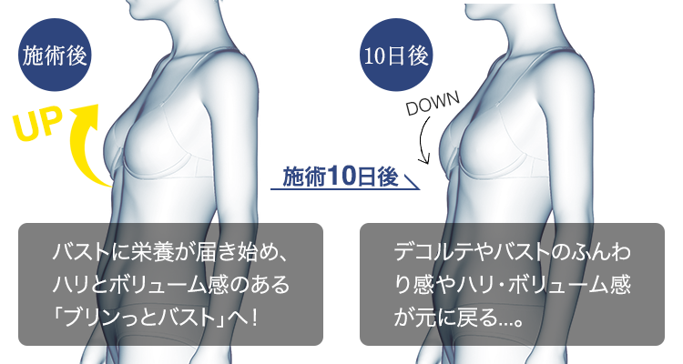 施術前 バストに栄養が届き始め、ハリとボリューム感のある「ブリンっとバスト」へ！ 10日後 デコルテやバストのふんわり感やハリ・ボリューム感が元に戻る・・・。