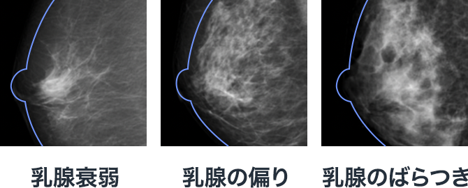 乳腺衰弱 乳腺の偏り 乳腺のばらつき